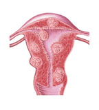 STK700176H
Anatomy of fibroid tumors in female uterus.