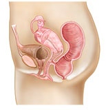 STK700186H
Rectovaginal fistula and cross section of female reproductive organs.