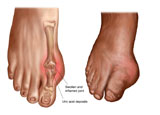 STK700229H
Anatomy of a swollen foot.