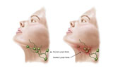 STK700231H
Anatomy of swollen lymph nodes.