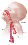 STK700239H
Anatomy of a tracheoesophageal fistula.