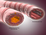 STK700350H
Trachea cross-section showing normal and asthmatic bronchiole.