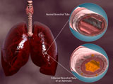 STK700351H
Trachea cross-section with lungs showing normal and asthmatic bronchiole.