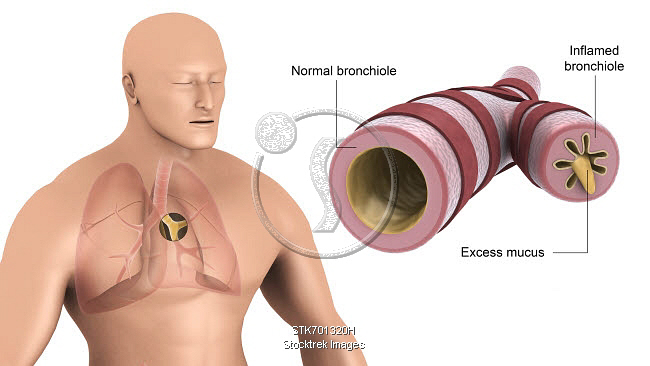 Bronke Medical illustration showing bronchitis in human lungs. | Stocktrek Images